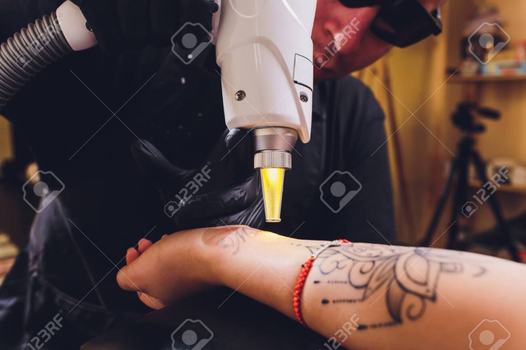 Tattoo Removal Options - Ibhulogi Blog